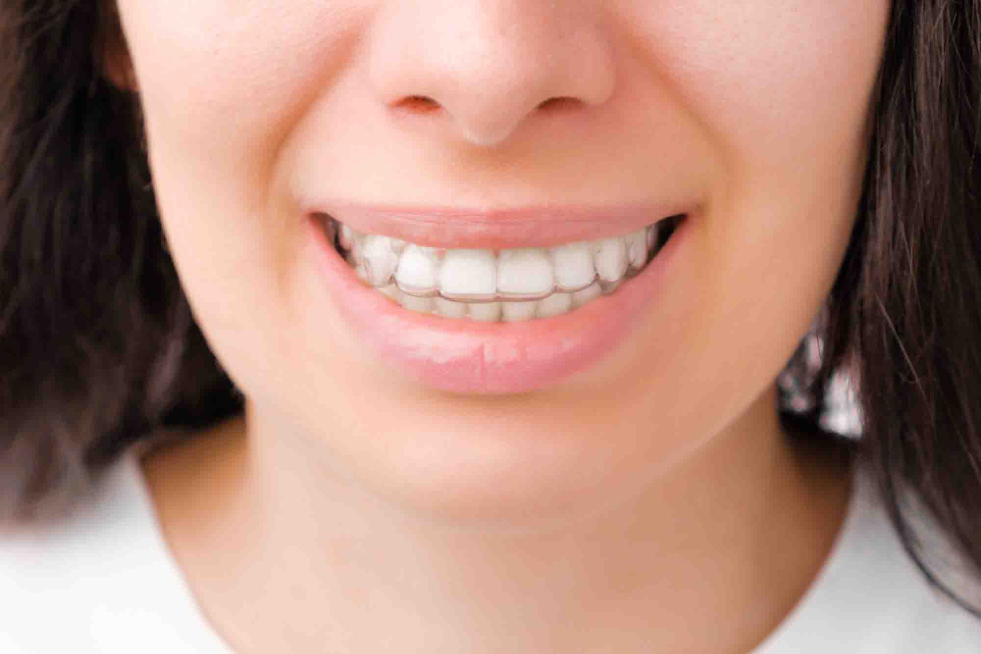 Invisalign Murcia