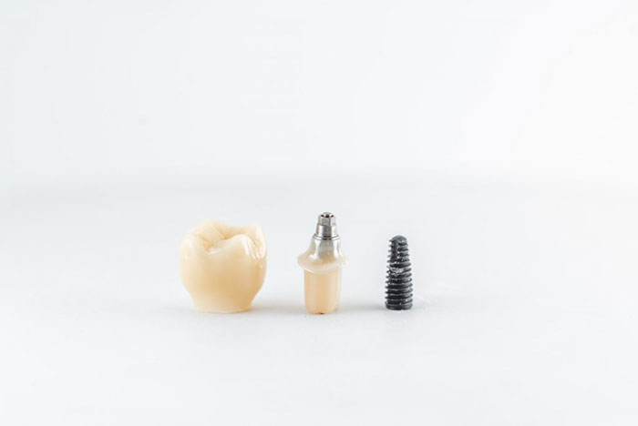 implantes dentales murcia