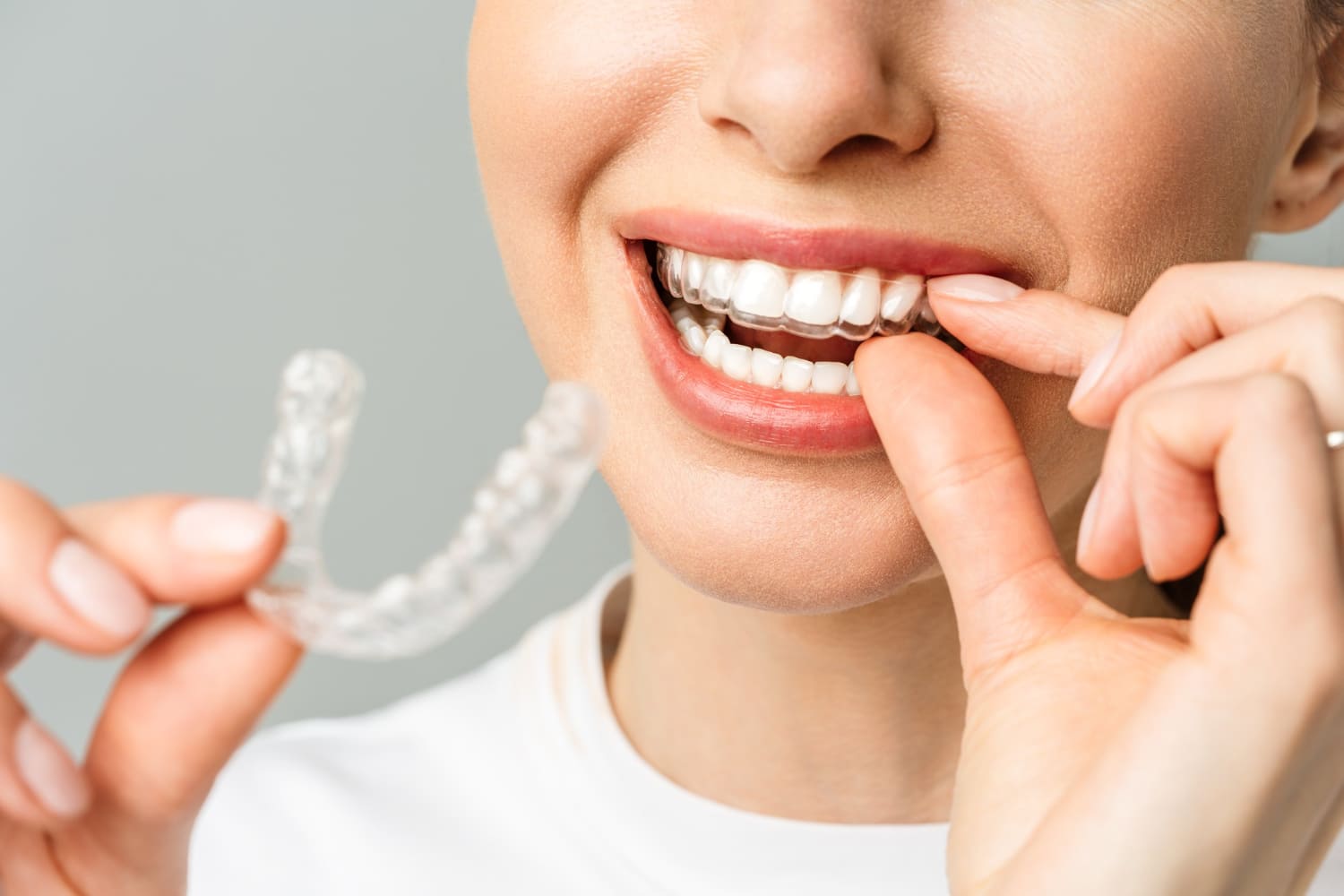 invisalign murcia